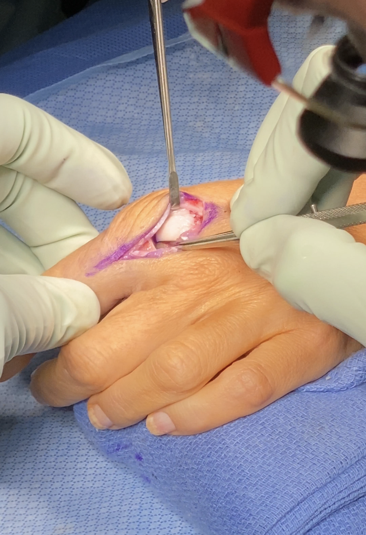 Intraoperative view of ALLIO at the MCP joint