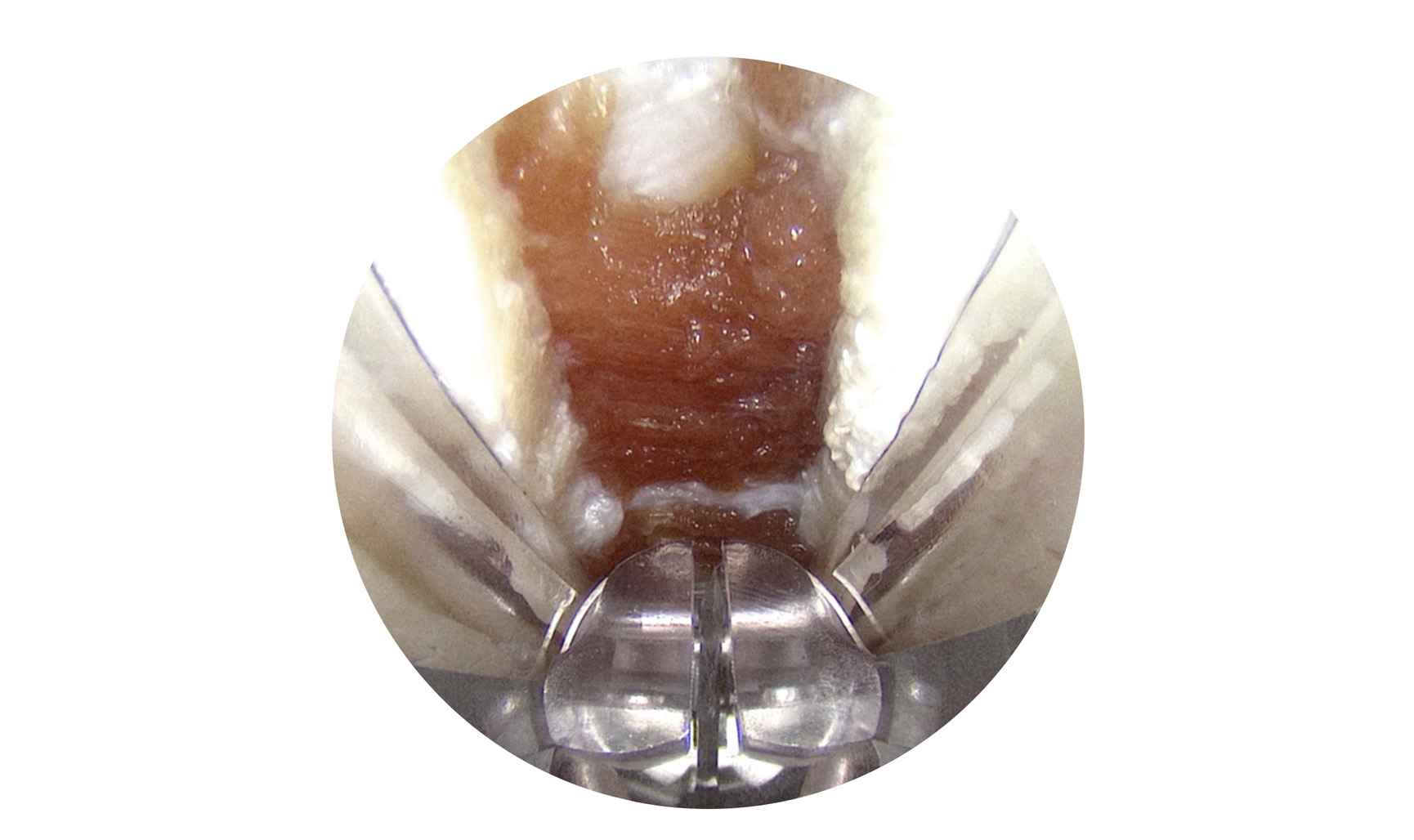 RETRA endoscopic view through the static cannula