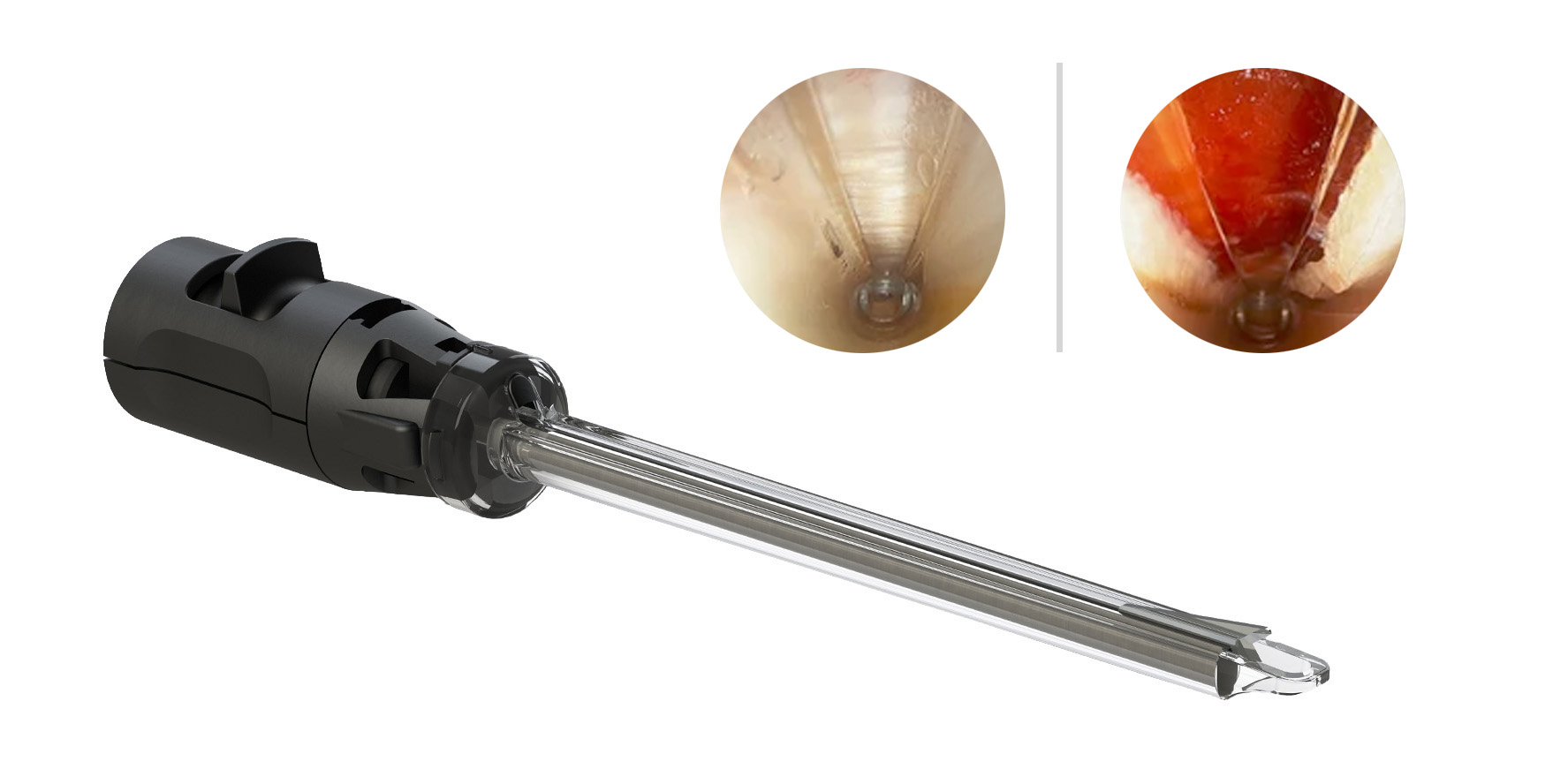 ULTRA endoscopic release system